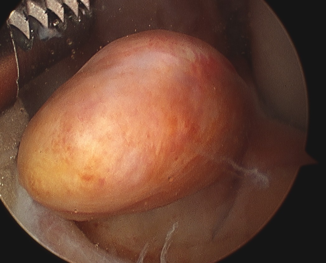 ACL Stump Arthroscopy